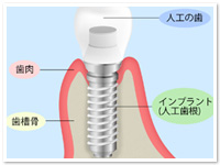 インプラント