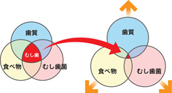 虫歯の原因とメカニズム