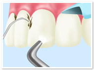 歯のクリーニング